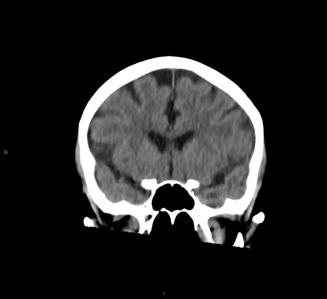 File:Cerebral amyloid angiopathy-associated lobar intracerebral hemorrhage (Radiopaedia 58757-65978 Coronal non-contrast 45).jpg