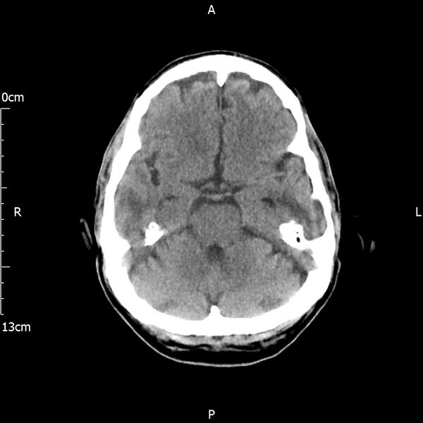 File:Cerebral amyloid angiopathy related inflammation (Radiopaedia 72772-83480 Axial non-contrast 9).jpg