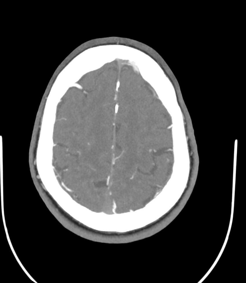 Cerebral dural venous sinus thrombosis (Radiopaedia 86514-102576 A 77).jpg