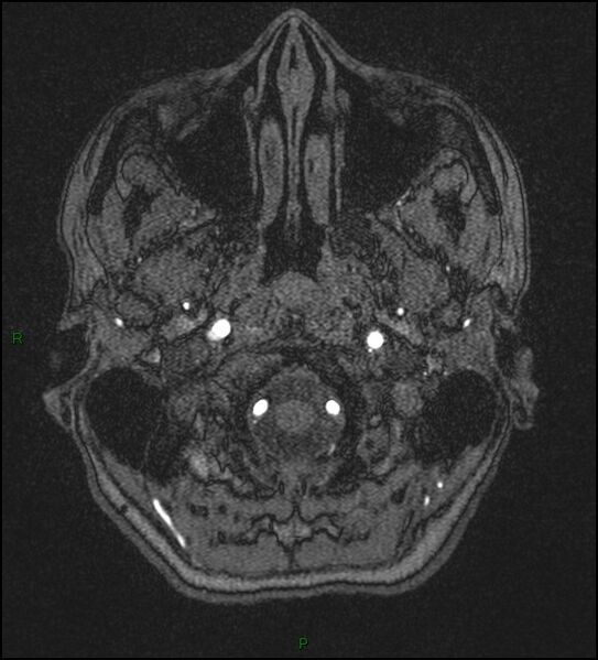 File:Cerebral fat embolism (Radiopaedia 35022-36525 Axial TOF 5).jpg