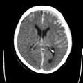 Cerebral hemorrhagic contusions (Radiopaedia 23145-23188 Axial non-contrast 22).jpg