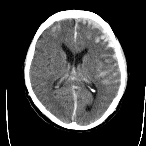 File:Cerebral hemorrhagic contusions (Radiopaedia 23145-23188 Axial non-contrast 22).jpg