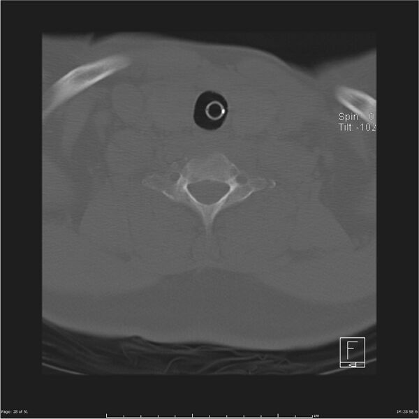 File:Cerebral hemorrhagic contusions and cervical spine fractures (Radiopaedia 32865-33841 C 28).jpg