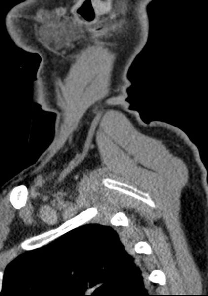 File:Cerebral hemorrhagic contusions and cervical spine fractures (Radiopaedia 32865-33841 G 11).jpg