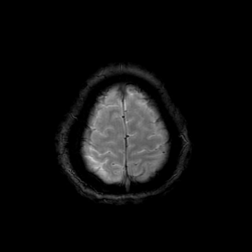 Cerebral paragonimiasis (Radiopaedia 73473-84238 Axial SWI 61).jpg