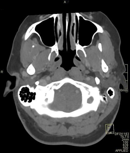 File:Cerebral venous sinus thrombosis (Radiopaedia 91329-108965 Axial venogram 12).jpg
