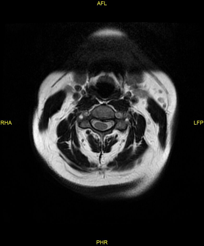 Cervical disc protrusion (Radiopaedia 87147-103415 Axial T2 1).jpg