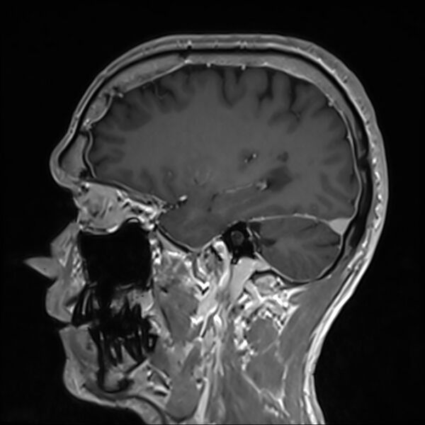 File:Cervical dural CSF leak on MRI and CT treated by blood patch (Radiopaedia 49748-54995 G 29).jpg