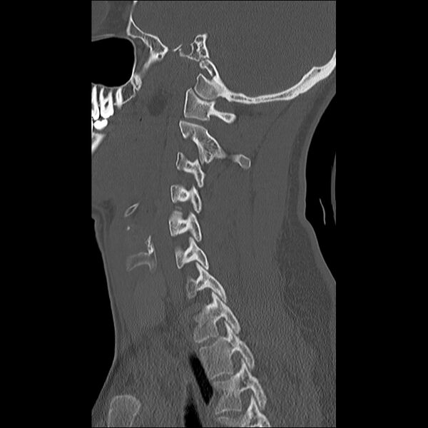 File:Cervical facet fracture and anterior discoligamentous injury (Radiopaedia 32139-33083 Sagittal bone window 11).jpg