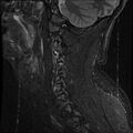 Cervical flexion teardrop fracture with cord hemorrhage (Radiopaedia 32497-33455 Sagittal STIR 3).jpg