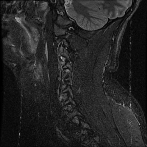 File:Cervical flexion teardrop fracture with cord hemorrhage (Radiopaedia 32497-33455 Sagittal STIR 3).jpg