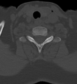 Cervical spine ACDF loosening (Radiopaedia 48998-54070 Axial bone window 46).png