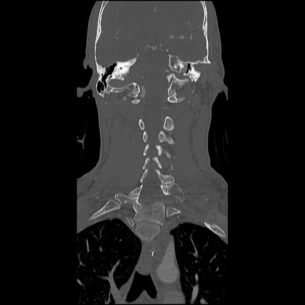 File:Cervical spine fractures with vertebral artery dissection (Radiopaedia 32135-33078 Coronal bone window 17).jpg