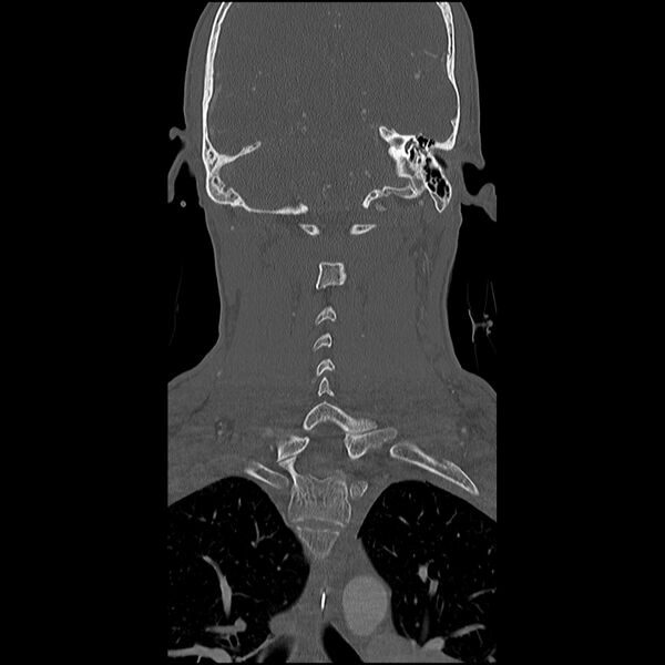 File:Cervical spine fractures with vertebral artery dissection (Radiopaedia 32135-33078 Coronal bone window 22).jpg