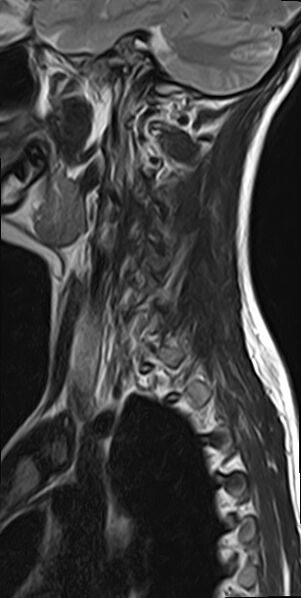 File:Cervical spondylodiscitis and calvarial hemangioma (Radiopaedia 64317-73104 Sagittal T2 1).jpg
