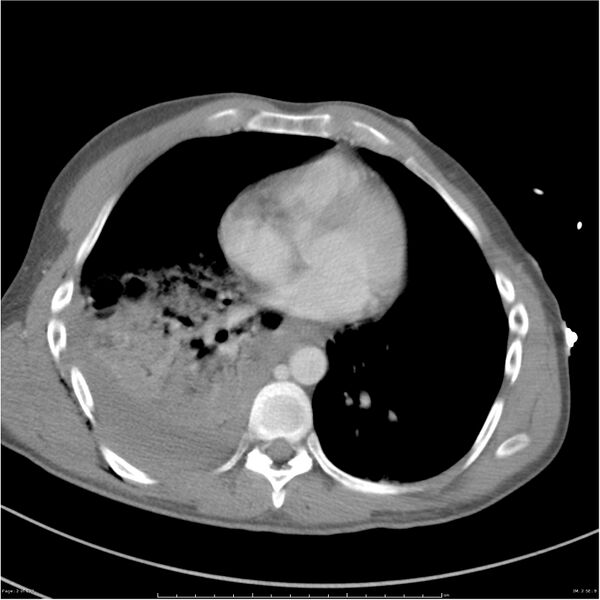 File:Chest and abdomen multi-trauma (Radiopaedia 26294-26426 bone window 2).jpg