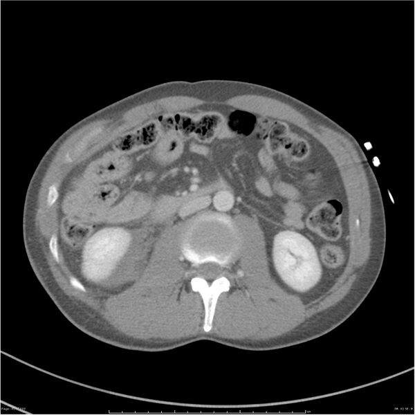 File:Chest and abdomen multi-trauma (Radiopaedia 26294-26426 bone window 41).jpg