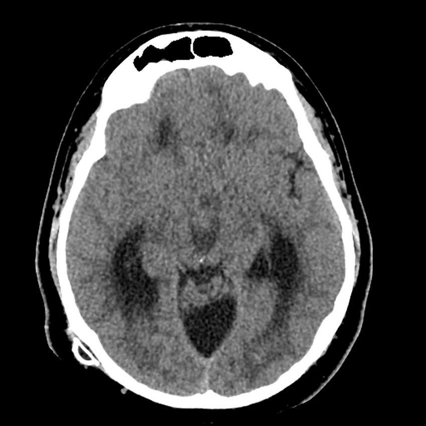 Chiasmatic-hypothalamic juvenile pilocytic astrocytoma (Radiopaedia 78533-91237 Axial non-contrast 26).jpg
