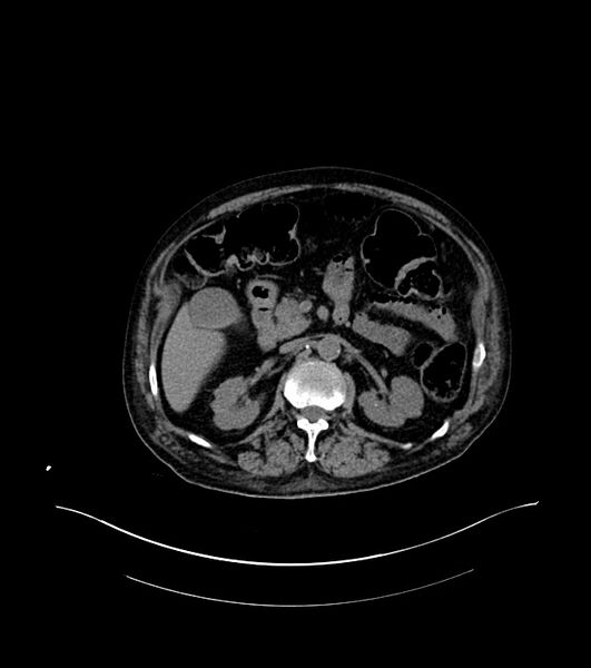 File:Cholangiocarcinoma with cerebral metastases (Radiopaedia 83519-98629 Axial non-contrast 39).jpg