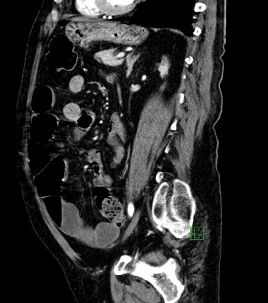 File:Cholangiocarcinoma with cerebral metastases (Radiopaedia 83519-98629 F 48).jpg
