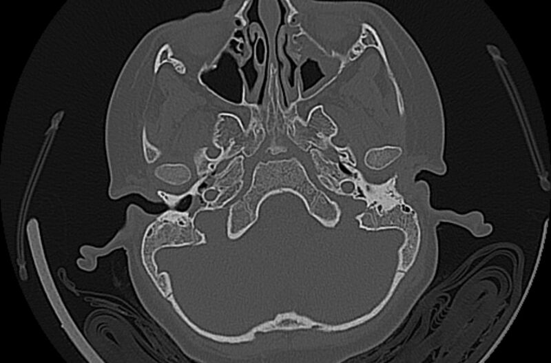 File:Cholesteatoma (Radiopaedia 73023-83750 Axial bone window 19).jpg