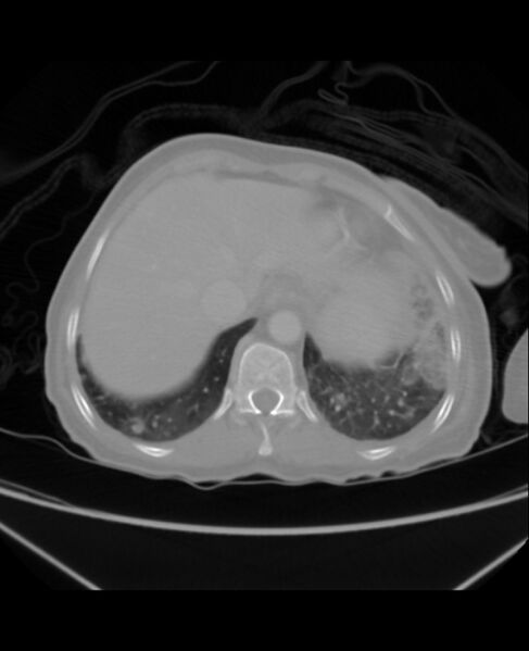 File:Chondrosarcoma (Radiopaedia 79427-92535 Axial lung window 45).jpg