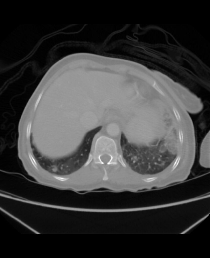 Chondrosarcoma (Radiopaedia 79427-92535 Axial lung window 45).jpg