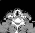 Chondrosarcoma - larynx (Radiopaedia 4588-6698 A 7).jpg