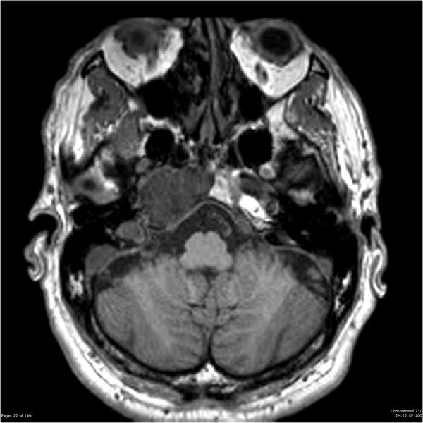 File:Chondrosarcoma of skull base- grade II (Radiopaedia 40948-43654 Axial T1 22).jpg