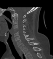Chordoma (C4 vertebra) (Radiopaedia 47561-52188 Sagittal bone window 40).png