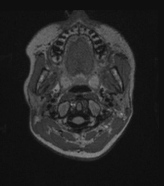File:Choroid plexus carcinoma (Radiopaedia 91013-108553 Axial FLAIR C+ 55).jpg