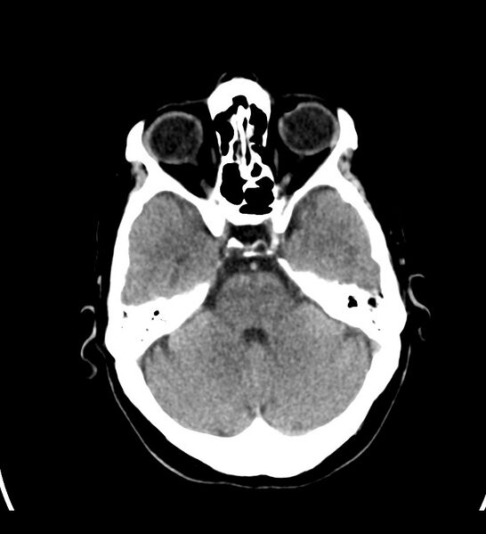 File:Choroid plexus xanthogranuloma (Radiopaedia 91271-108874 Axial non-contrast 12).jpg
