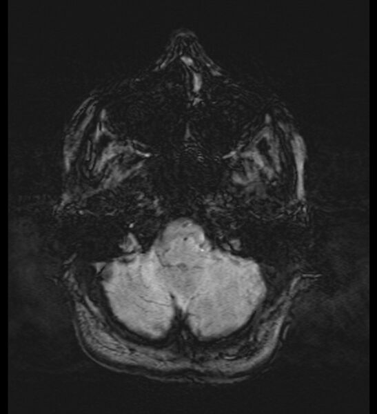 File:Choroid plexus xanthogranuloma (Radiopaedia 91271-108875 Axial SWI 12).jpg