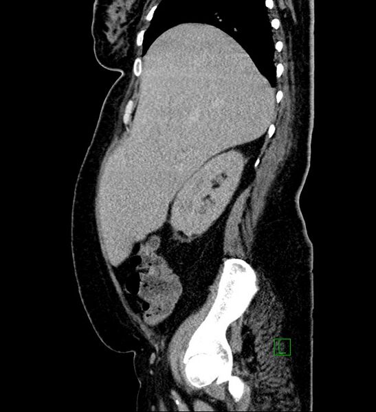 File:Chromophobe renal cell carcinoma (Radiopaedia 84239-99519 G 88).jpg