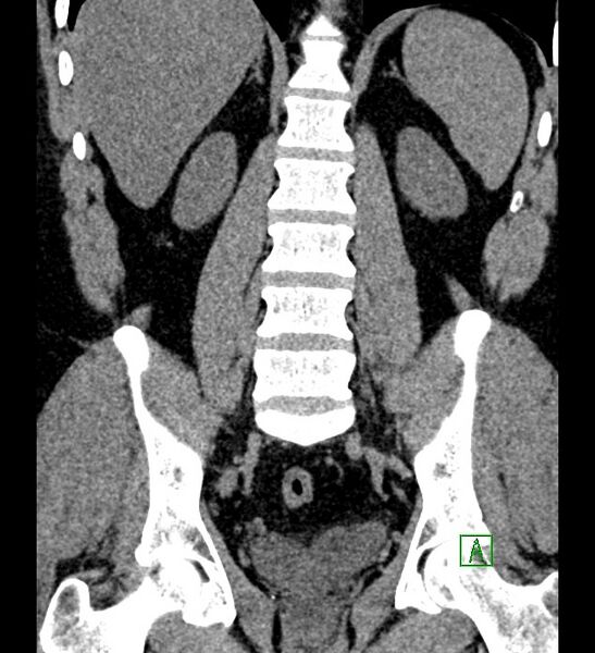 File:Chromophobe renal cell carcinoma (Radiopaedia 84286-99573 Coronal non-contrast 120).jpg