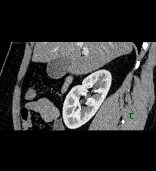 File:Chromophobe renal cell carcinoma (Radiopaedia 84286-99573 F 118).jpg