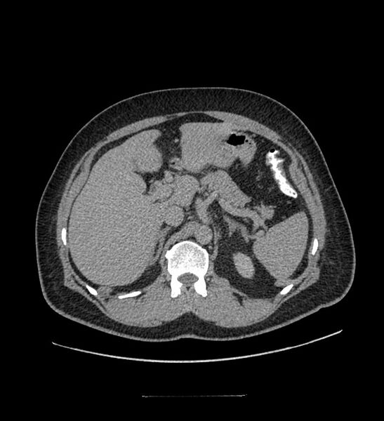 File:Chromophobe renal cell carcinoma (Radiopaedia 84337-99644 Axial C+ delayed 40).jpg