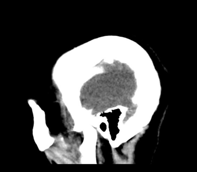 File:Chronic bilateral occipital lobe infarcts (Radiopaedia 31276-31996 C 35).jpg