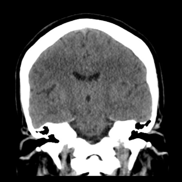 File:Chronic bilateral occipital lobe infarcts (Radiopaedia 31276-31996 Coronal non-contrast 27).jpg