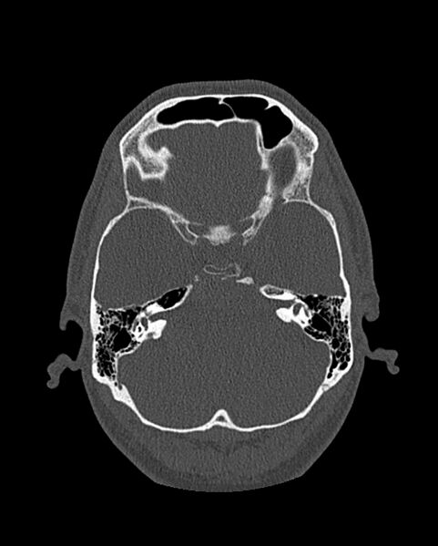 File:Chronic maxillary sinusitis caused by a foreign body (Radiopaedia 58521-65676 Axial bone window 258).jpg