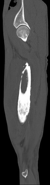 File:Chronic osteomyelitis (with sequestrum) (Radiopaedia 74813-85822 C 87).jpg