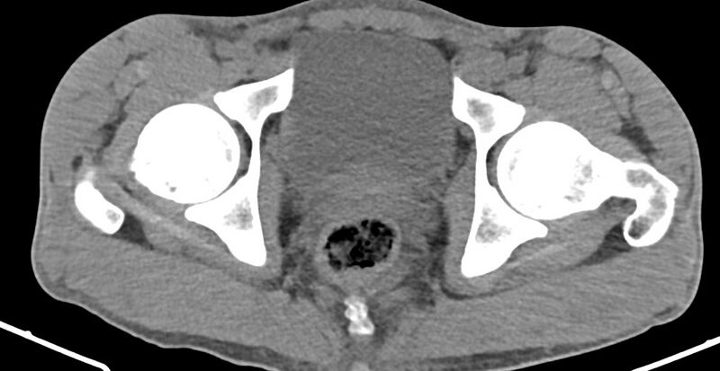 File:Chronic osteomyelitis (with sequestrum) (Radiopaedia 74813-85822 D 39).jpg