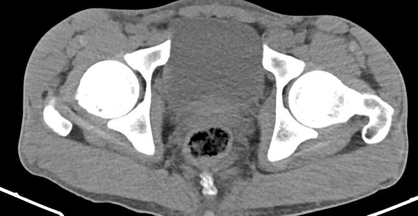 Chronic osteomyelitis (with sequestrum) (Radiopaedia 74813-85822 D 39).jpg