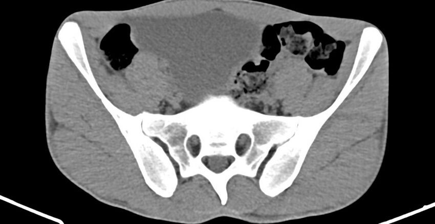 Chronic osteomyelitis (with sequestrum) (Radiopaedia 74813-85822 D 7).jpg