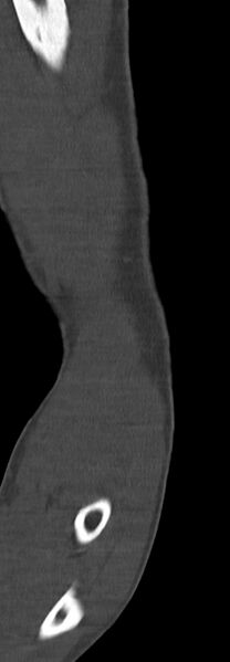 File:Chronic osteomyelitis of the distal humerus (Radiopaedia 78351-90971 Sagittal bone window 33).jpg