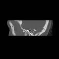 Chronic otomastoiditis (Radiopaedia 27138-27309 Sagittal bone window 5).jpg