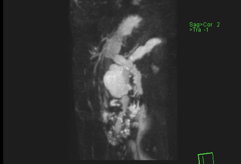 File:Chronic pancreatitis - pancreatic duct calculi (Radiopaedia 71818-82250 MRCP T2 15).jpg