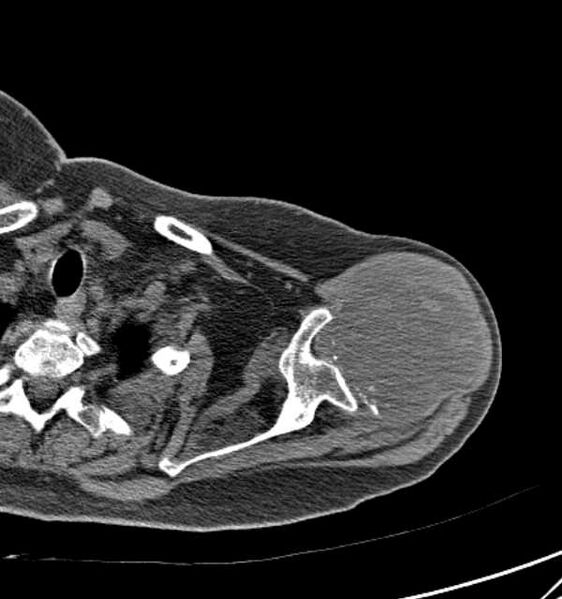 File:Clear cell chondrosarcoma - humerus (Radiopaedia 63104-71612 Axial non-contrast 28).jpg