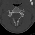 Cleft of the posterior arch of C1 mimicking fracture (Radiopaedia 40201-42721 Axial bone window 4).jpg