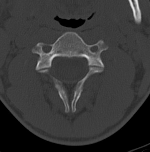 File:Cleft of the posterior arch of C1 mimicking fracture (Radiopaedia 40201-42721 Axial bone window 4).jpg